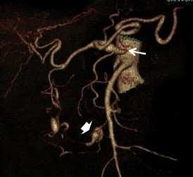 Visceral aneurysm Most аsymptomatic. Found incidentally on imaging.