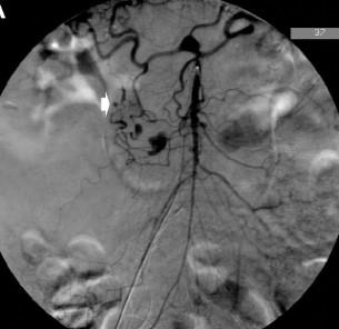 1/3 of patients concomitant aneurysms.