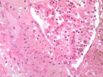 Question 6: Metastatic Melanoma to H&E 10x the gallbladder This epithelioid tumour shows