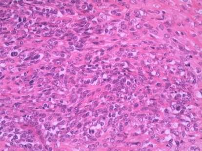 Question 13: Mesenchymal Chondrosarcoma This had cellular areas with atypical small cells in a fine