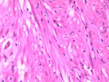 Question 14: Inflammatory Myofibroblastic Tumour The spindle celled and sometimes fascicular nature of