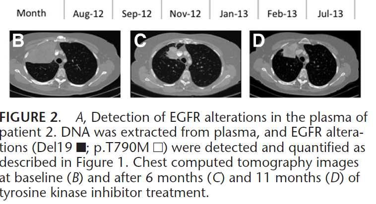 Case Study 2 Title only (a) 63 yo, female, never-smoker Cough and weight loss Large tumor upper lobe right lung and single bone metastasis ex19del mutation detected in both lung biopsy and plasma