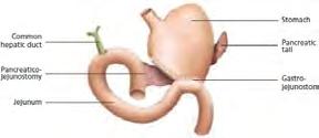 distal pancreatectomy and splenectomy.