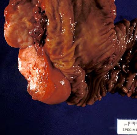 IV. Neoplastic - Other PANet (Pancreatic Neuroendocrine tumors) with extrapancreatic extension
