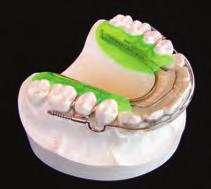 resetting of teeth) Uses nickel titanium coil springs in both