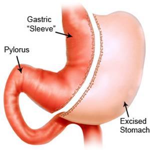 Vertical Sleeve Gastrectomy Photo