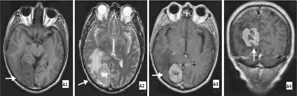 Central nervous system lymphoma Fig.1: MRI performance for head of typical PCNSL patients.