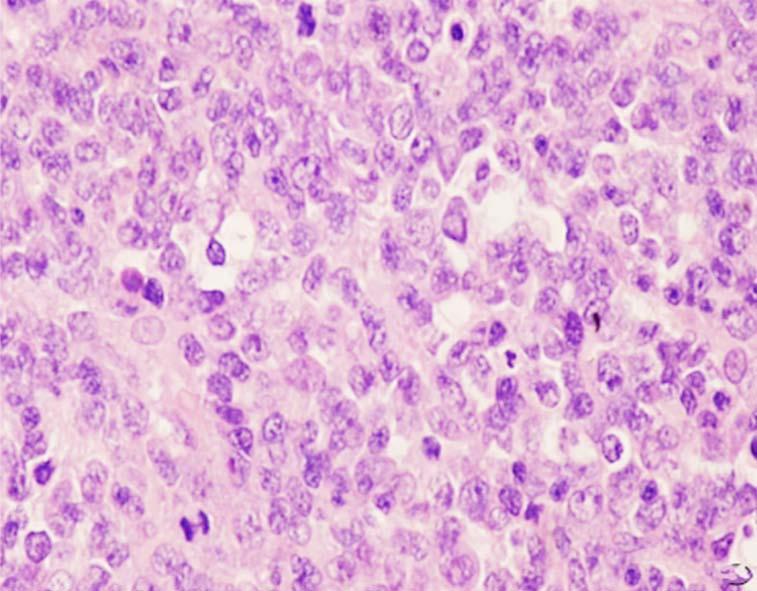 Shanhua Zhang et al. Fig.3: Male, 55 year-old (HE, 200). Note: pathologically confimred as Burkkit lymphoma; intensively distributed cancer cells with obvious mitotic figure and sky star phenomena.
