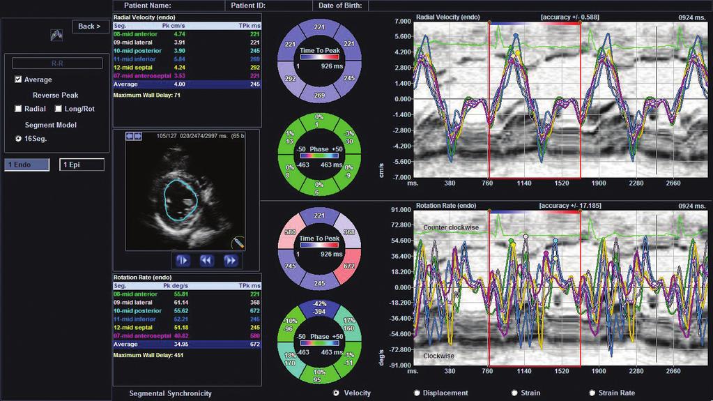 ALPINION s Auto IMT software for carotid scan, provides simple operation and accurate measurement results by calibrating the thickness of