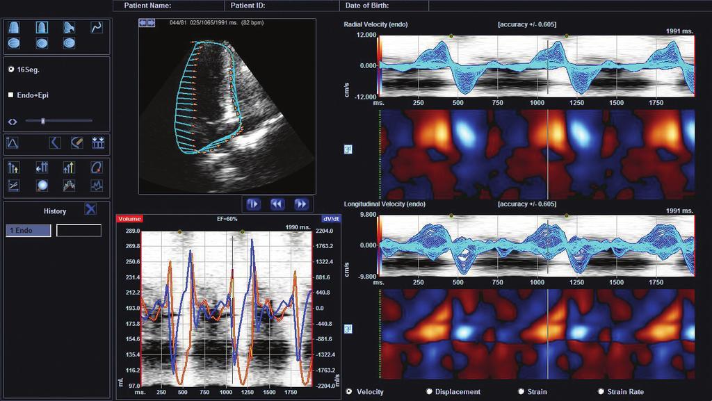 TDI, Cube Strain TDI software helps in the quantitative and objective assessment of left ventricle wall motion function.