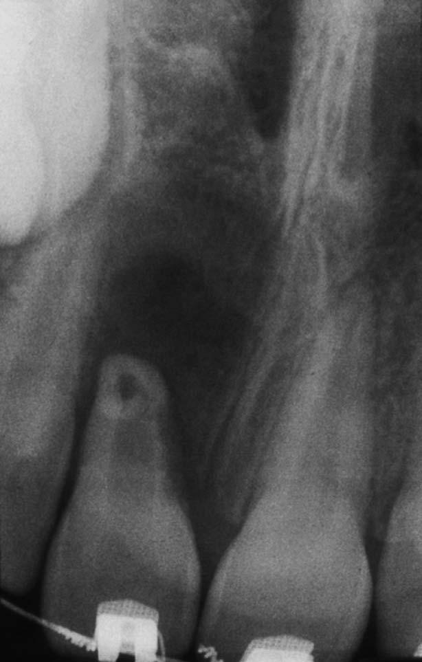 106 Malčić et al. July 2006 Fig. 2. Bull s eye apperance of orofacially directed dilaceration of the root of maxillary central incisor before endodontic treatment.