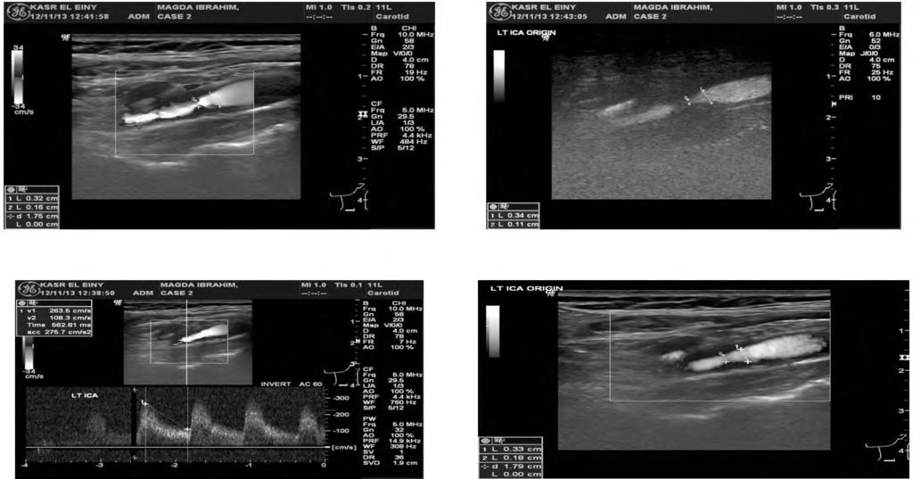 808 B-Flow, Power Doppler & Color Doppler Ultrasound (A) (B) (C) (D) Fig. (3): Same patient as shown in Fig.