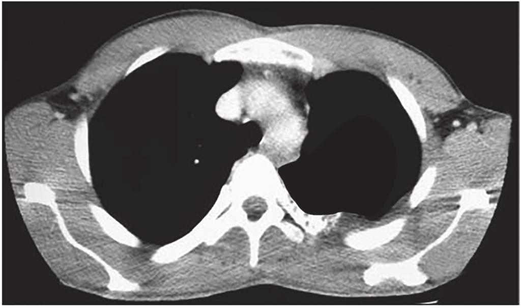 (b) The MRI image shows that Tomek does not have any internal injuries (Fig. 4.1). 16 B C D A Fig. 4.1 The image shows a cross-section through Tomek s chest cavity.