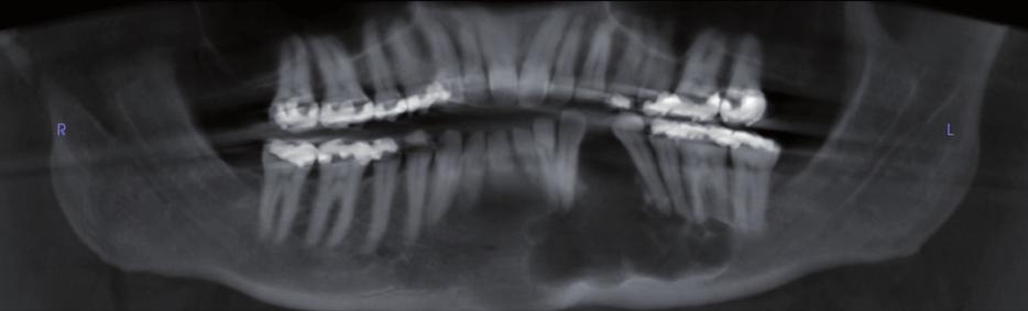 findings of GOC often resemble those of odontogenic keratocyst or ameloblastoma, the former presenting as a unilocular radiolucency with scalloped borders and the latter as a multilocular and