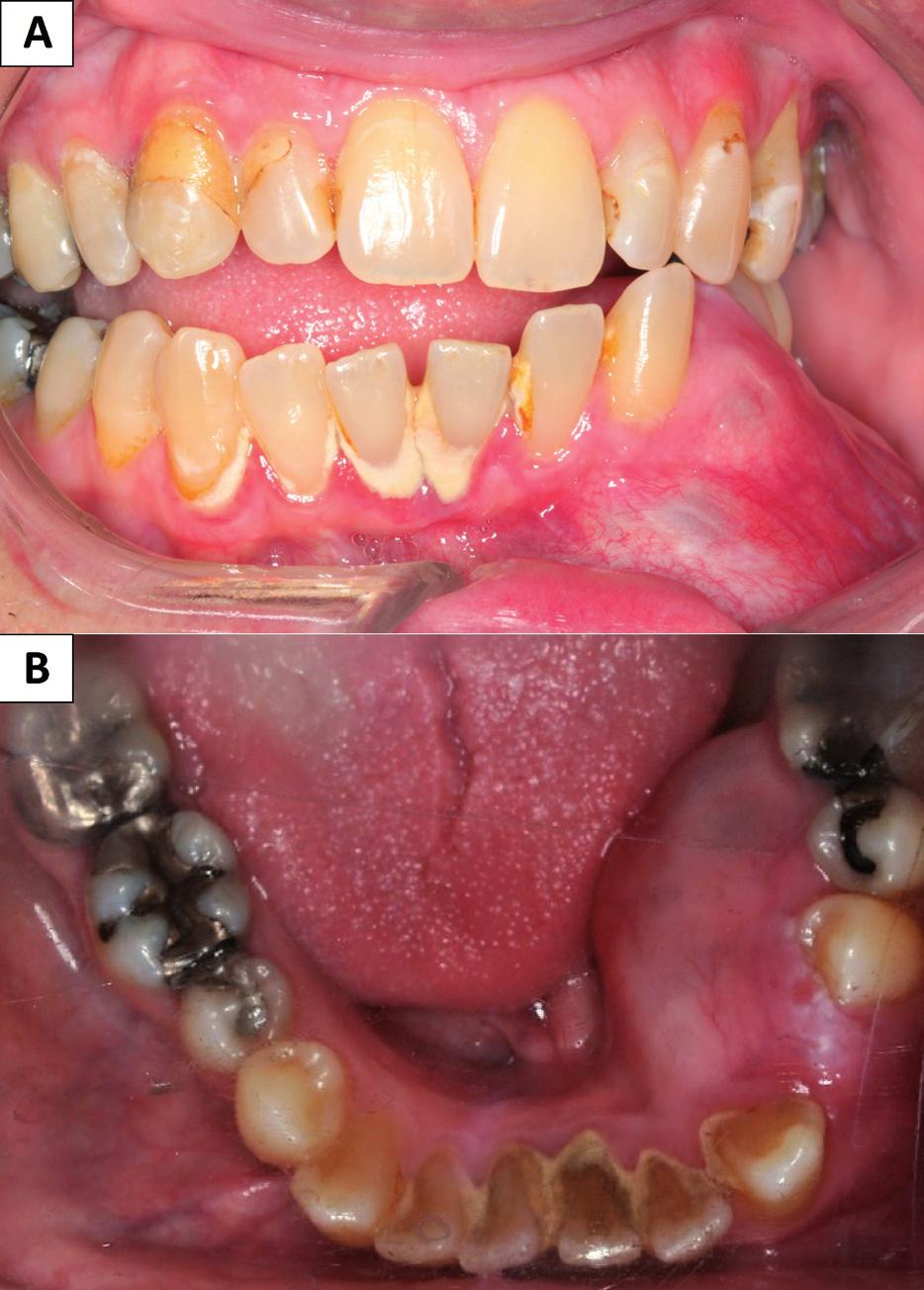 Histologically, GOC may have features overlapping with botryoid odontogenic cyst, dentigerous cyst, and low-grade mucoepidermoid carcinoma (2,8), but not with ameloblastoma.