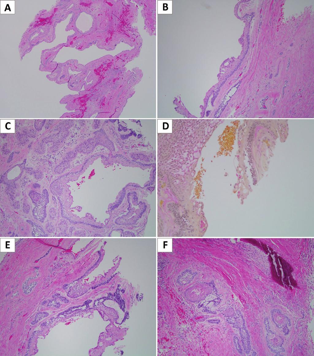 Fig. 3: Histologic presentation of the GOC & Ameloblastoma.