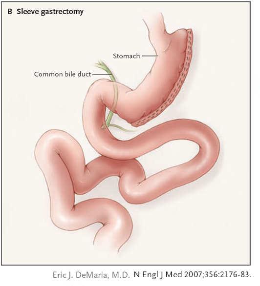 Bypass stricture of gastrojejunostomy (2-3%) treatment: dilation during endoscopy Band acute pouch outlet obstruction (0-10%) treatment: nasogastric tube marginal ulceration (3-5%) treatment: