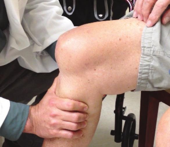 PCL LAXITY Complications Associated with Excessive PCL Laxity An excessively lax PCL will cause flexion instability, exhibited by post-operative knee pain,