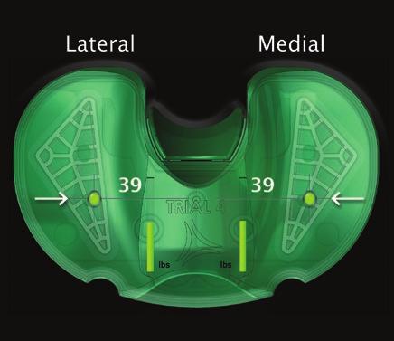the medial and lateral compartments due to tension in the PCL Surgeon is adding 2 of posterior slope to increase the