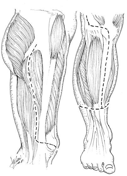 SHAREEF JANDALI AND DAVID W. LOW Figure 1. Illustration of incisions for pedicled fillet of leg flap.