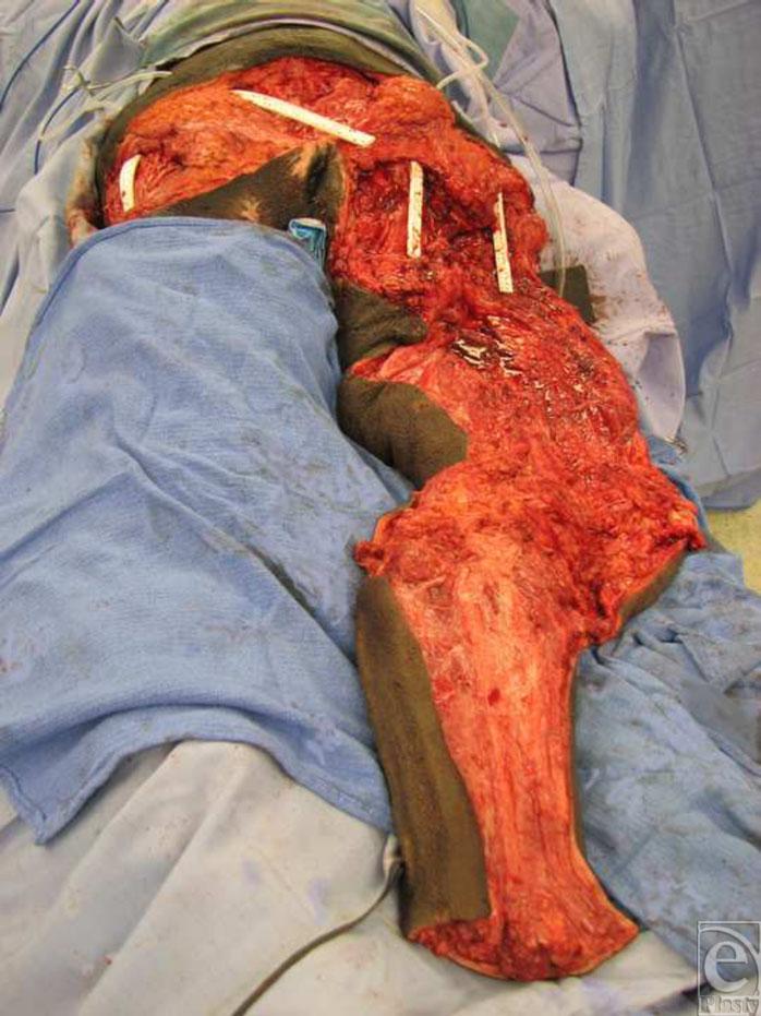 eplasty VOLUME 9 Figure 3. Drain placement prior to insetting of leg flap.