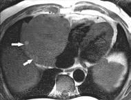 Osteosarcoma Pre-Gd T1W Image Heterogeneous RA mass Foci
