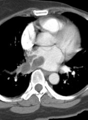 vein Metastases often at presentation (lung, lymph