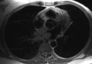 myocardium Invades Pulmonary Veins Osteosarcoma Post-Gd