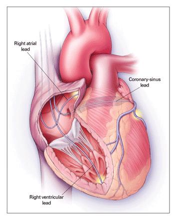 CRT Cardiac