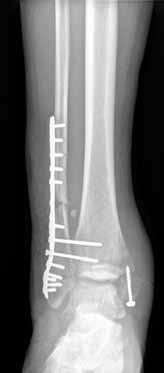 ntibiotic Cement Coated Plates for Management of Infected Fractures are not routinely used unless there is high risk for hematoma formation.