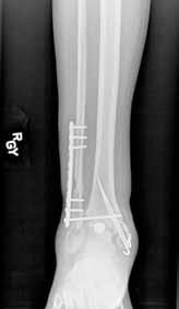 Clinical Series Case 1 31-year-old man fell from a ladder and sustained a bimalleolar ankle fracture-dislocation that was treated with ORIF.