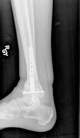 Case 2 27-year-old male carpenter fell from a height of 12 feet and sustained a fracture of the distal radius that was treated with external fixation.