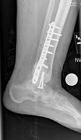 t 5 months postoperatively, the Figure 7. Case 3 Radiograph plate was removed because obtained 12 months postoperatively shows osseous union of of pain.
