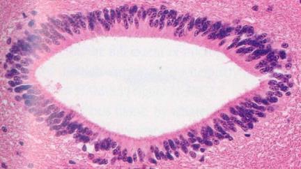 numerous in 3rd ventricle Choroid Plexus
