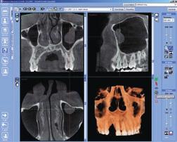 With the Planmeca Romexis 3D Explorer software, each patient study can be stored on a CD with Planmeca Romexis 3D Viewer for others to view.