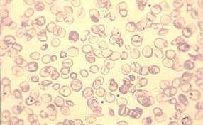 Hypochromic microcytic anemia with few target cells: