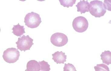 Echinocytes (Burr cells): circumferential small monomorphic
