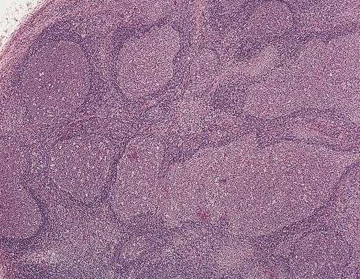 Reactive follicular hyperplasia: note the enlarged follicles, variable sizes and