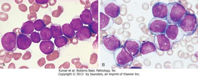 Morphology: lymphoblasts (left) have fine chromatin, minimal agranular cytoplasm compared to