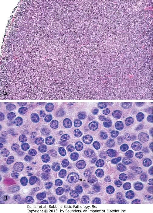 Small lymphocytic lymphoma: A: Low-power view shows diffuse effacement of nodal architecture.