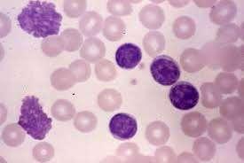 CLL: Peripheral blood shows