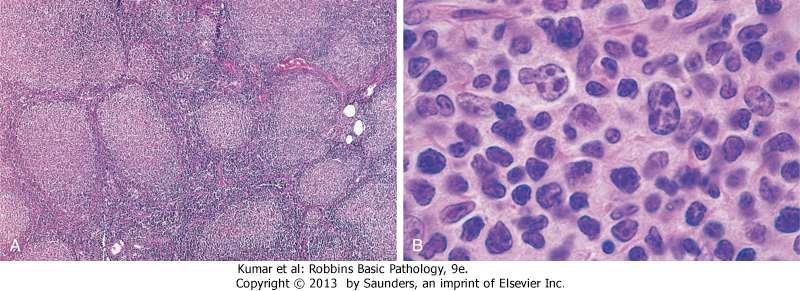 Follicular lymphoma: A, Nodular aggregates of lymphoma cells are present throughout B, At high magnification, small lymphoid cells with