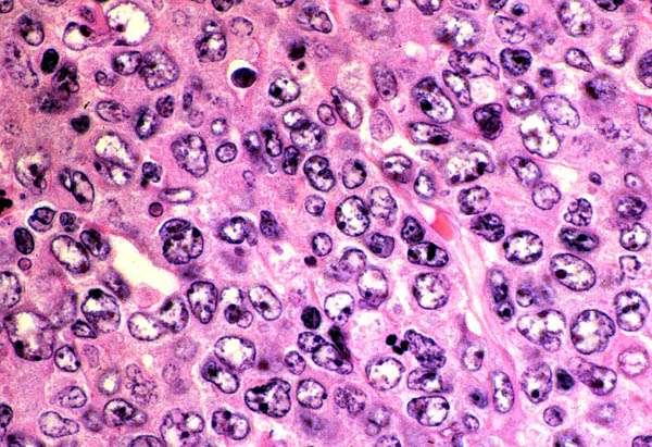 DLBCL: lymphoma cells have large nuclei (>2x normal