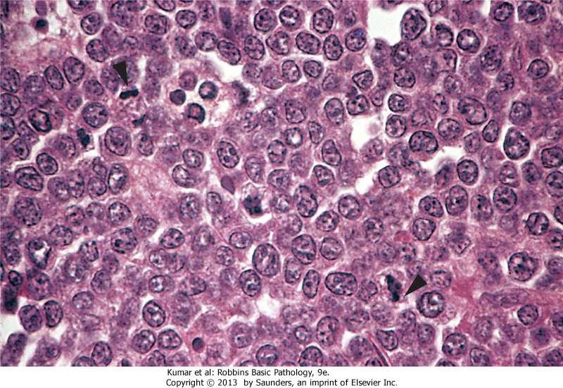 Burkitt lymphoma (High power view): The tumor cells and their nuclei are fairly uniform and intermediate