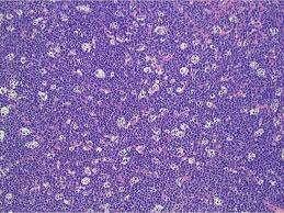 The "starry sky" appearance is characteristic of Burkitt lymphoma on low power view.