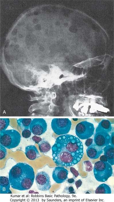 Plasma cell myeloma: A) X-ray shows numerous bone lytic lestion in the skull and other bones B) Normal marrow cells are largely