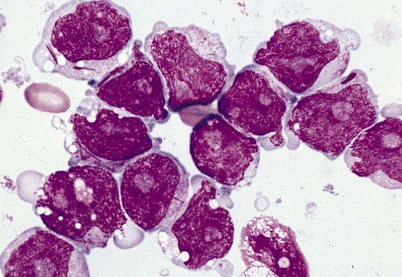 AML: myeloblasts show increased N/C ratio but a relatively abundant cytoplasm.