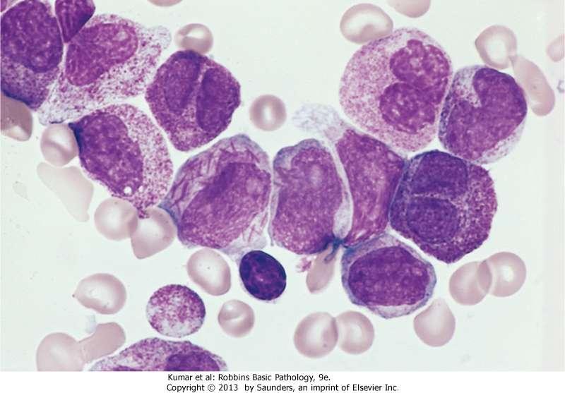 Acute promyelocytic leukemia: The neoplastic promyelocytes have abnormally coarse and numerous azurophilic granules.