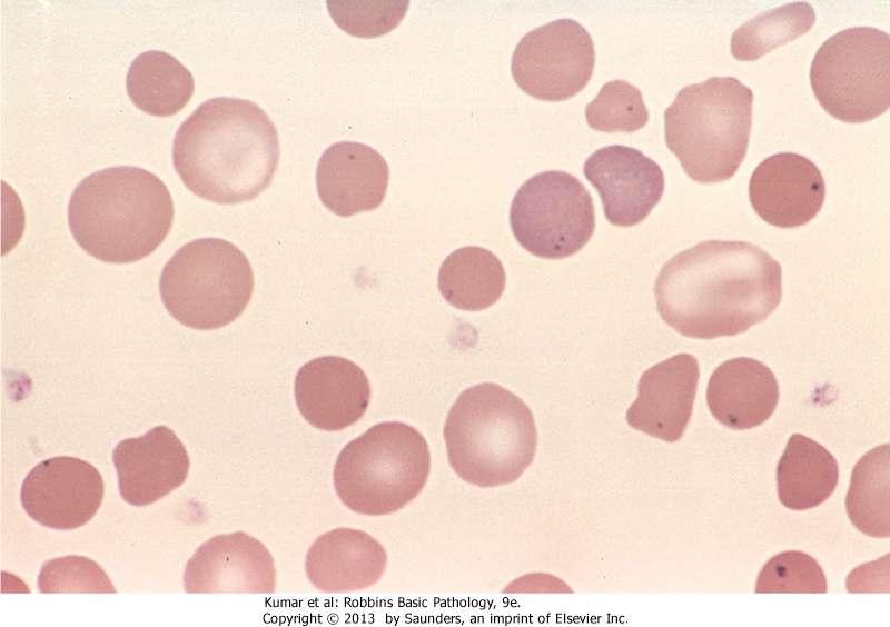 Spherocytes: appear small, round hyperchromatic RBCs (no central pallor).
