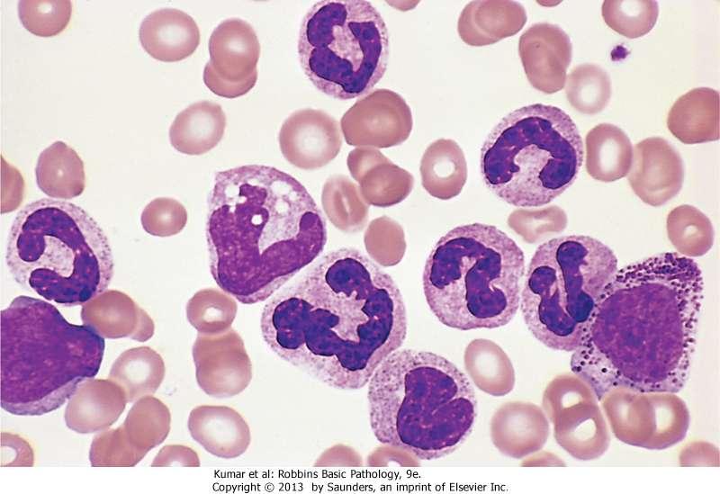Chronic myeloid leukemia, peripheral blood smear: Granulocytic forms